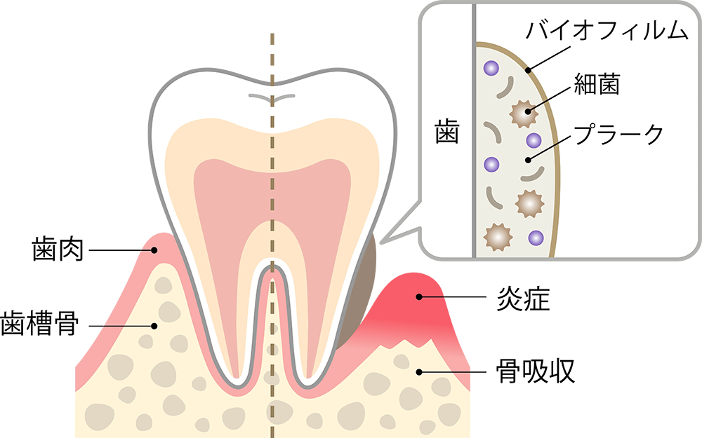 健康な歯と歯周病の図