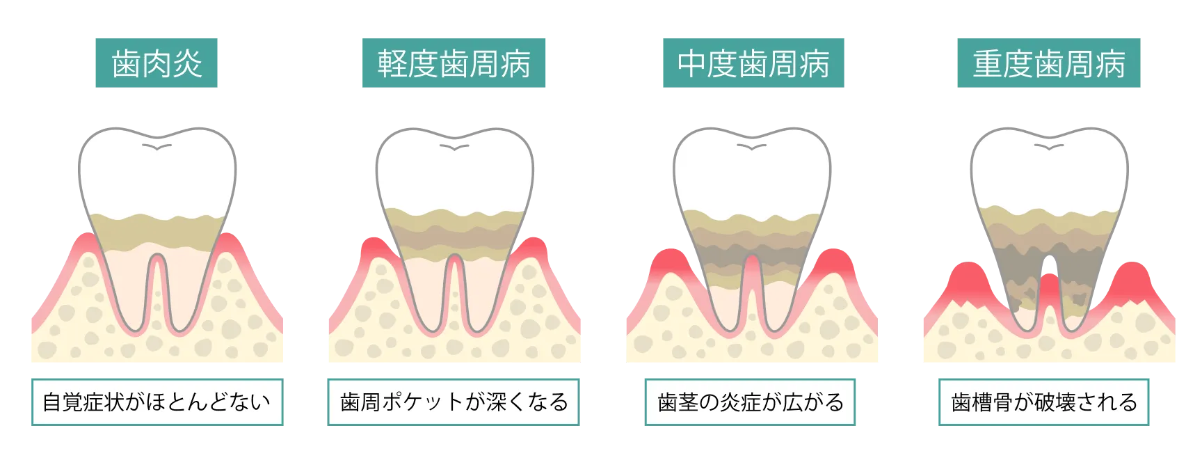 歯周炎の進行図：歯肉炎）自覚症状がほとんどない／軽度歯周病）歯周ポケットが深くなる／中度歯周病）歯茎の炎症が広がる／重度歯周病）歯槽骨が破壊される