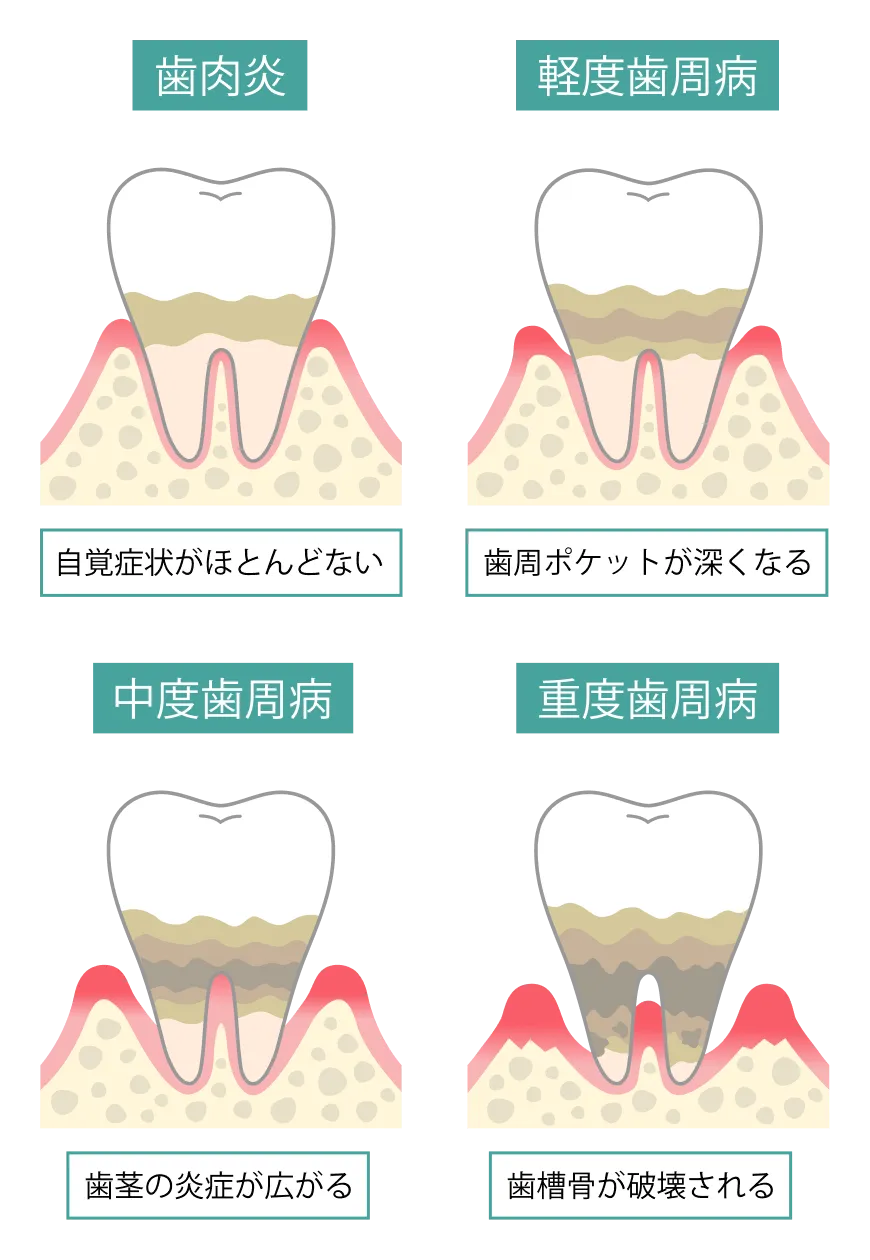 歯周炎の進行図：歯肉炎）自覚症状がほとんどない／軽度歯周病）歯周ポケットが深くなる／中度歯周病）歯茎の炎症が広がる／重度歯周病）歯槽骨が破壊される